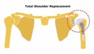 Total Shoulder Replacement. Shoulder joint replacement, endoprosthetics. Osteoarthrosis of the shoulder joint. Vector illustration. Flat design.