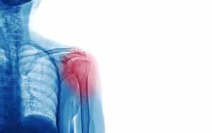 X Ray image of patient who have shoulder pain isolated on white background, space for your message and idea medical concept